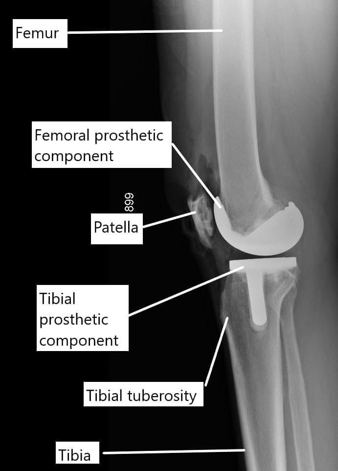 La radiografía muestra un reemplazo total de rodilla.