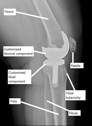 Radiografía que muestra un reemplazo de rodilla personalizado.