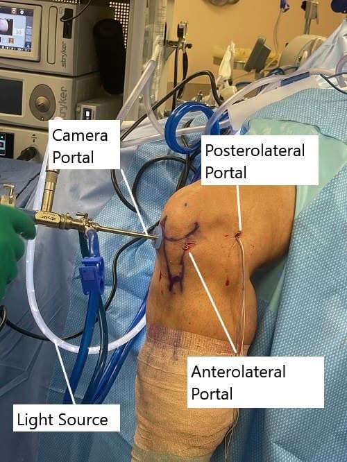 Imagen intraoperatoria que muestra la reconstrucción artroscópica del LCA de la rodilla.