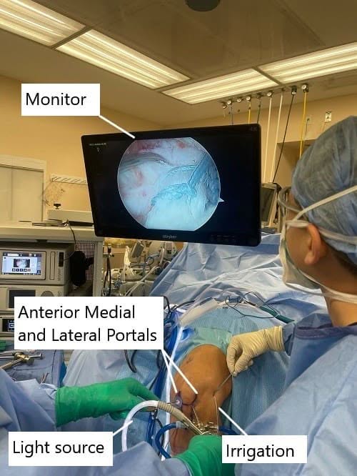 Imagen intraoperatoria que muestra la reconstrucción del LCA.