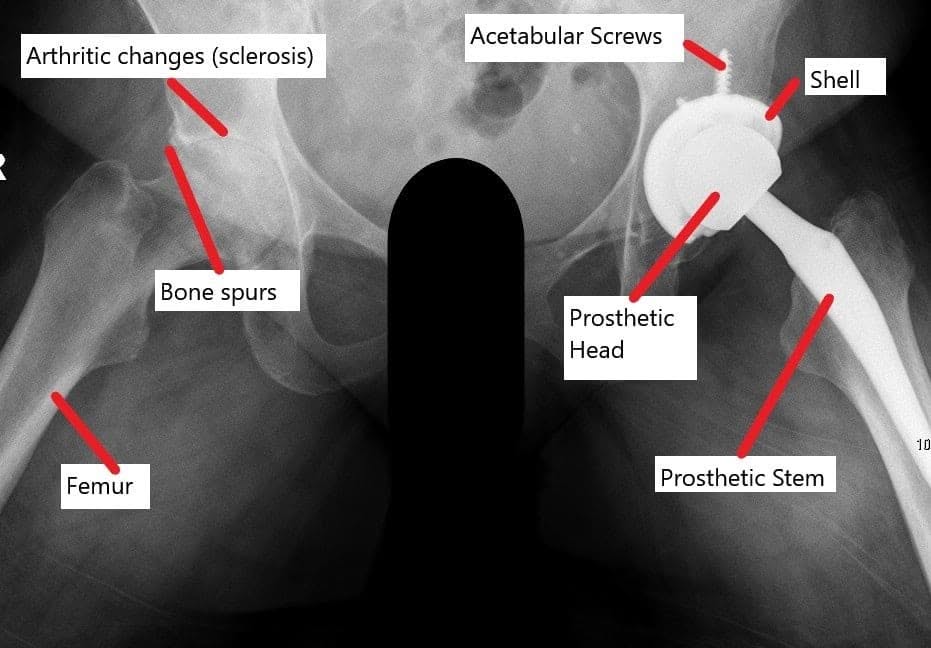 Radiografía que muestra un reemplazo total de cadera con una articulación artrítica contralateral.