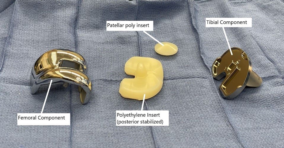 Imagen intraoperatoria que muestra los implantes de prótesis de rodilla.