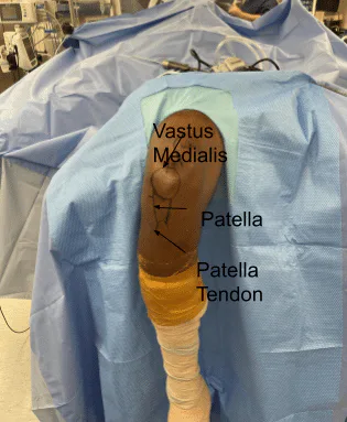 Actual footage of the operation