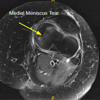 La resonancia magnética de la rodilla izquierda sugirió un desgarro radial del menisco medial y un esguince/desgarro del ligamento colateral medial.