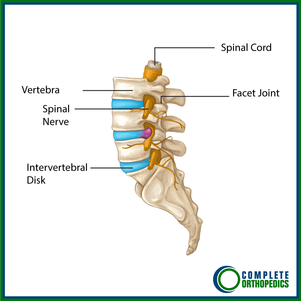 Diagram of herniated disc or prolapsed intervertebral disk Diagram of herniated disc or prolapsed intervertebral disk