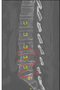Disc bulge and facet arthropathy