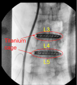 Intraoperative X-ray