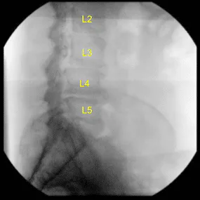 Intraoperative X-ray