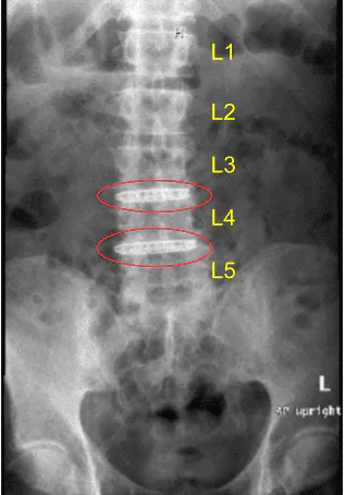 Postoperative X-ray
