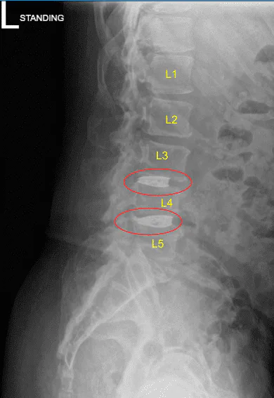 Postoperative X-ray Saggital View
