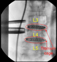 Postoperative X-ray