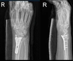AP and Lateral View of Patient RT 2 weeks Post-operative