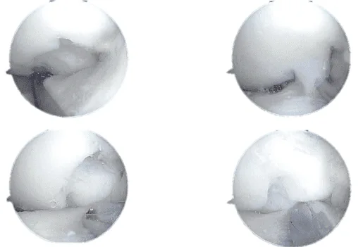 Arthroscopic view tear of the lateral meniscus posterior horn