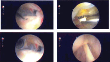 Imágenes de artroscopia intraoperatoria