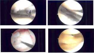 Imágenes de artroscopia intraoperatoria