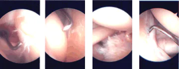 Imágenes de artroscopia intraoperatoria