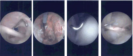 Imágenes de artroscopia intraoperatoria