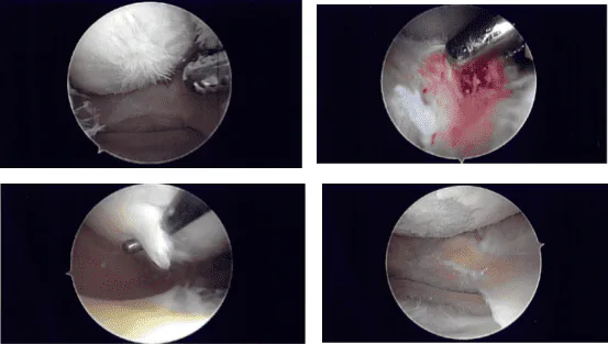 Intraoperative Arthroscopy Images