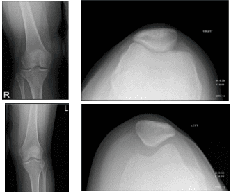Knee X-ray complete with patella