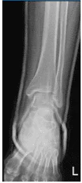Left Ankle X-Ray complete 3 or more views