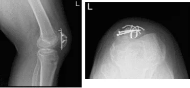 Left Knee Xray Complete with Patella