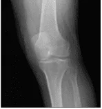 Radiografía de rodilla izquierda AP y lateral con vistas oblicuas