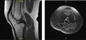 Resonancia magnética -3 T rodilla izquierda sin contraste
