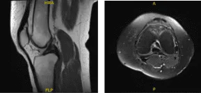 Resonancia magnética -3 T rodilla izquierda sin contraste