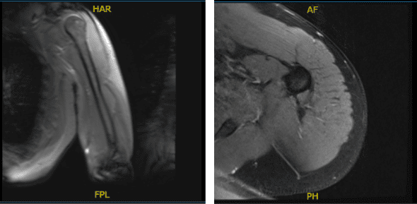 MRI-3T Brazo izquierdo sin contraste