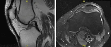 MRI-3T Left Knee Non-contrast