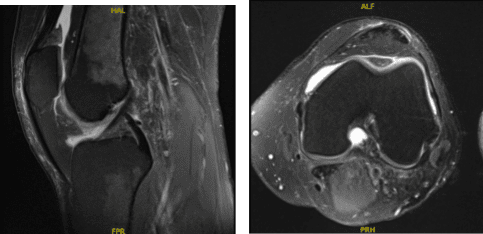 MRI-3T Left knee non-contrast