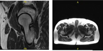 MRI-3T cadera derecha sin contraste