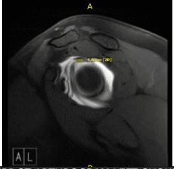 Artrograma MRI-3T en hombro izquierdo