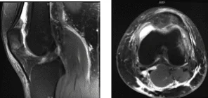 MRI Left Knee non-contrast
