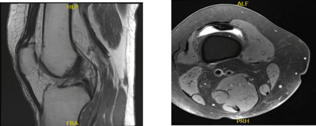 Resonancia magnética de rodilla derecha sin contraste