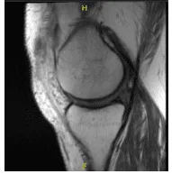 MRI presented to post operative visit, no visibility of the cyst