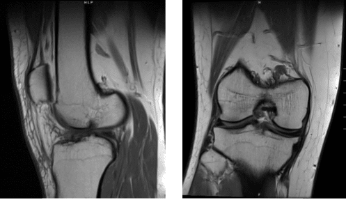 Escaneo por resonancia magnética de la rodilla derecha