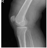 Radiografía de rodilla derecha AP y lateral con vistas oblicuas 3