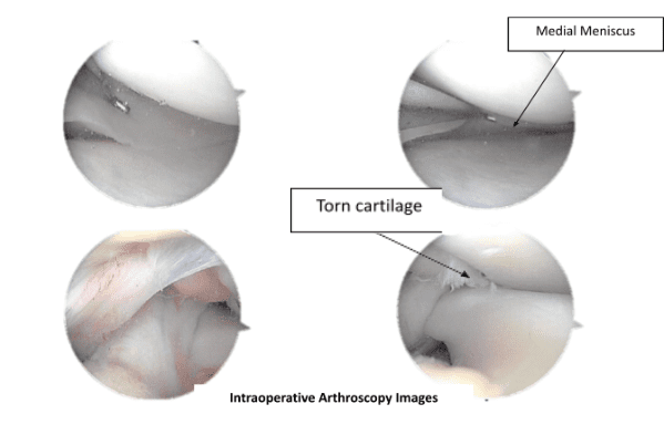 Imágenes de artroscopia intraoperatoria
