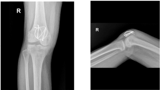 Imagen de rayos X rodilla derecha