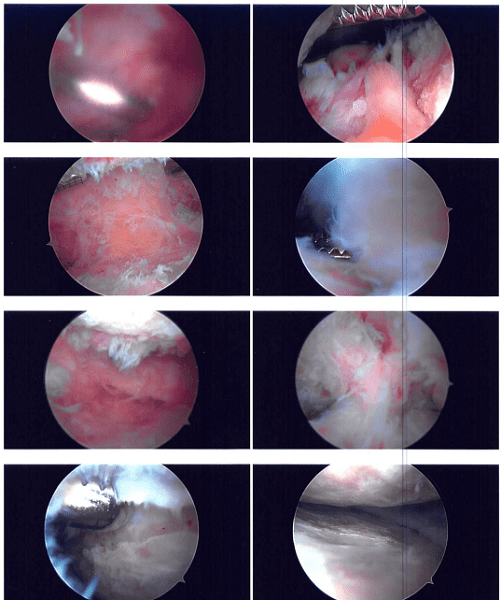Intraoperative photo