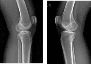 X-ray Bilateral Knees 3 views each