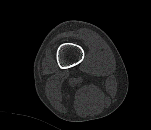 CT-Right Knee Non-contrast