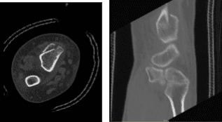 CT Right wrist non-contrast