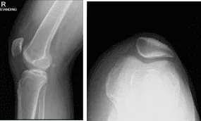Right knee X-ray complete with Patella