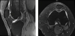 MRI-3 Left knee non-contrast