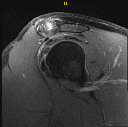 Imágenes de artroscopia intraoperatoria
