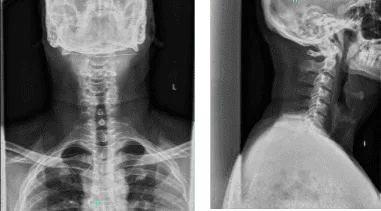 X-ray cervical spine 2 or 3 views