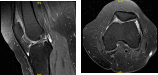 MRI Left knee non-contrast