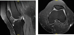MRI Left knee non-contrast